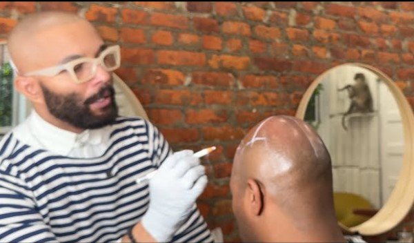 Scalp Micropigmentation Treatments